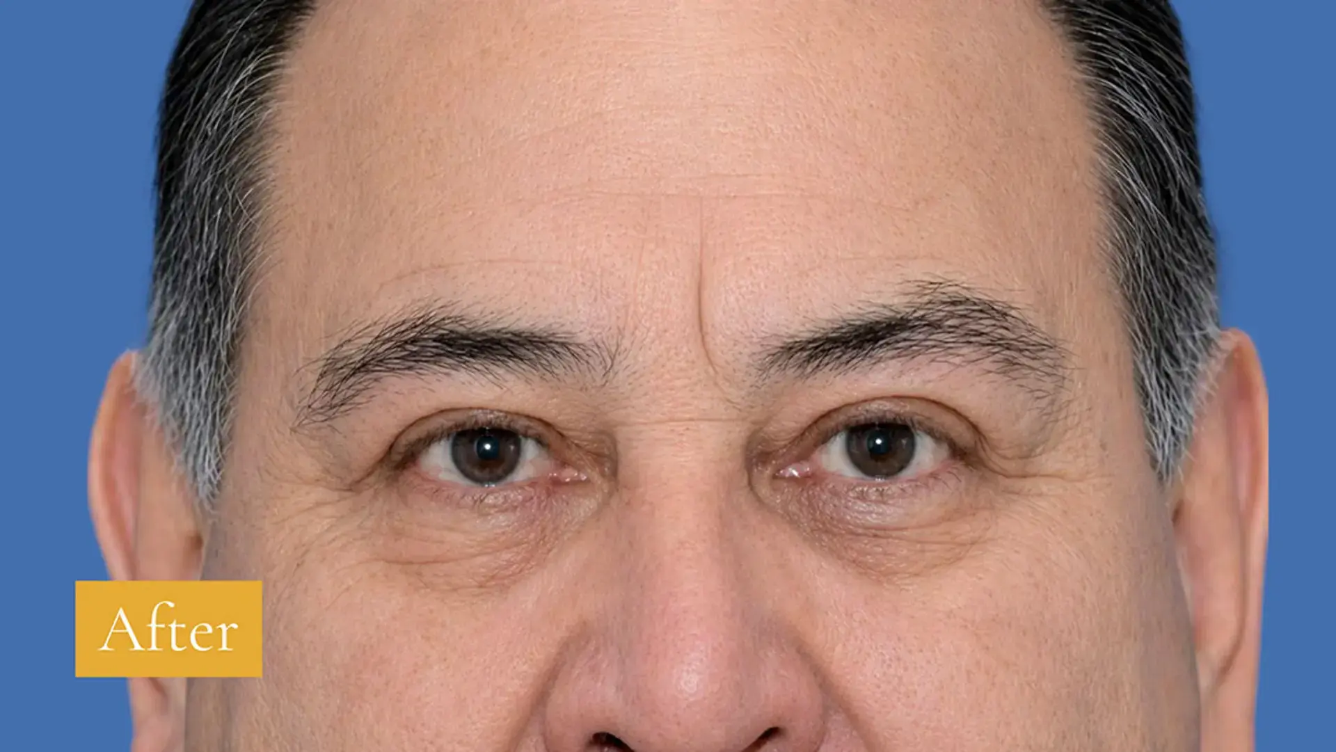 After eyebrow lift and upper eyelid surgery, click to view larger
