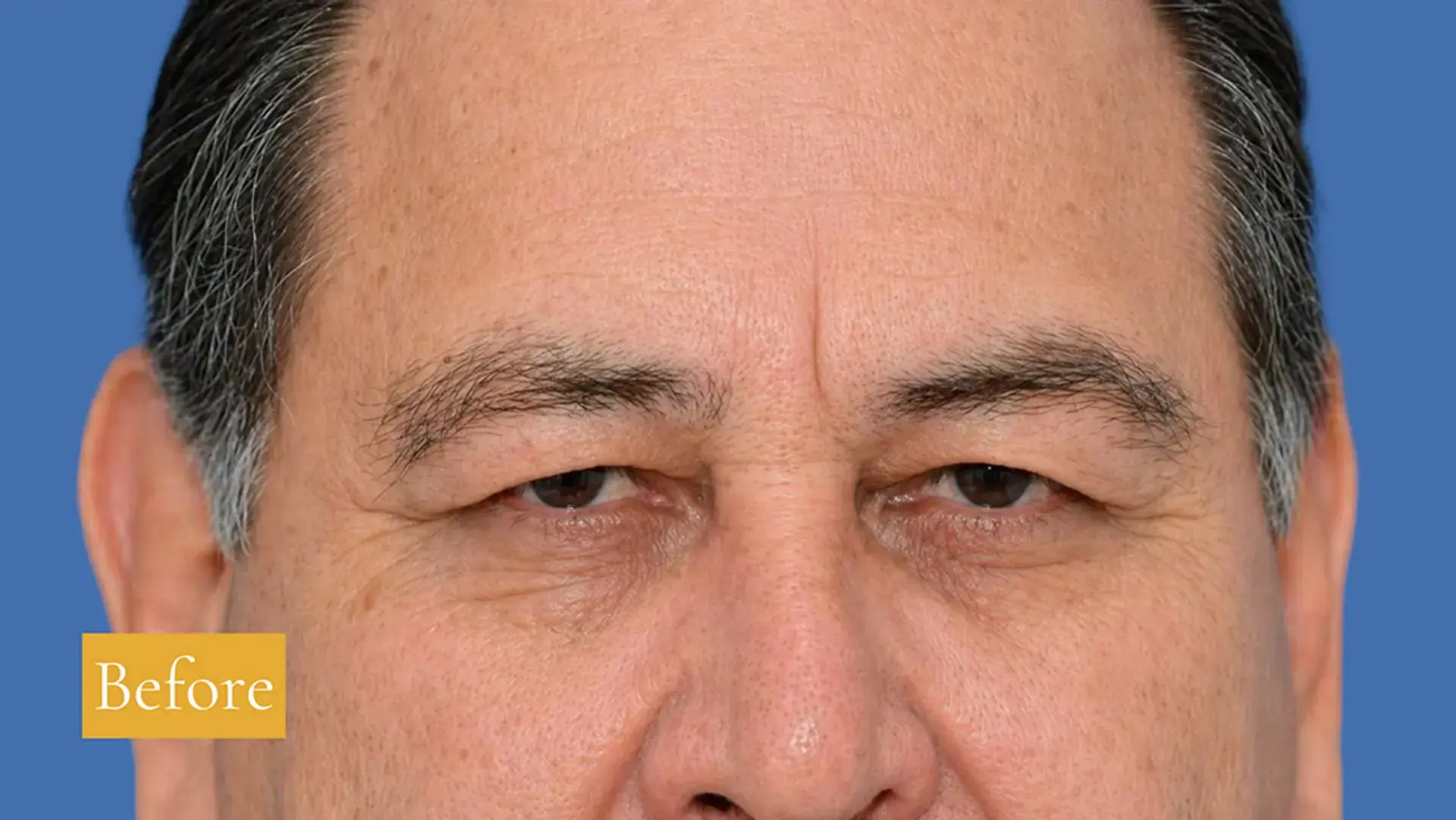 Before eyebrow lift and upper eyelid surgery, click to view larger