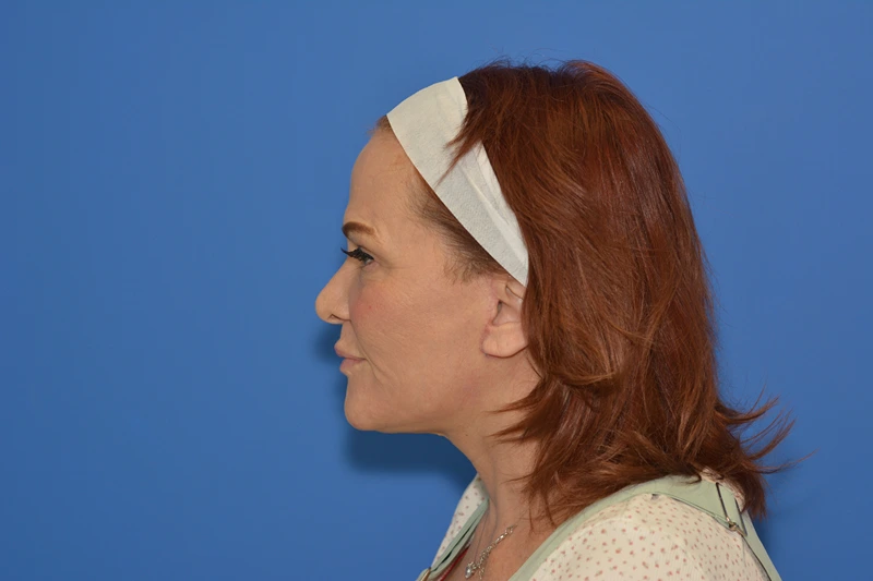 Same patient after facial rejuvenation with Dr. V
