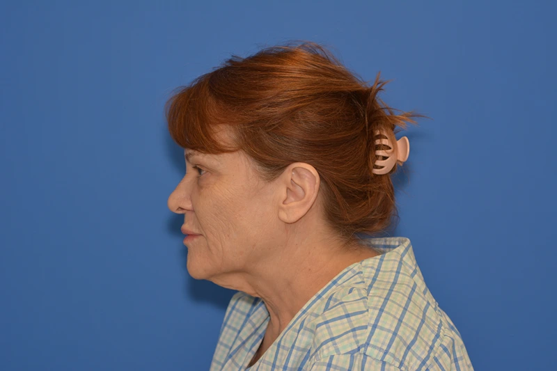 Patient before facial rejuvenation with Dr. V