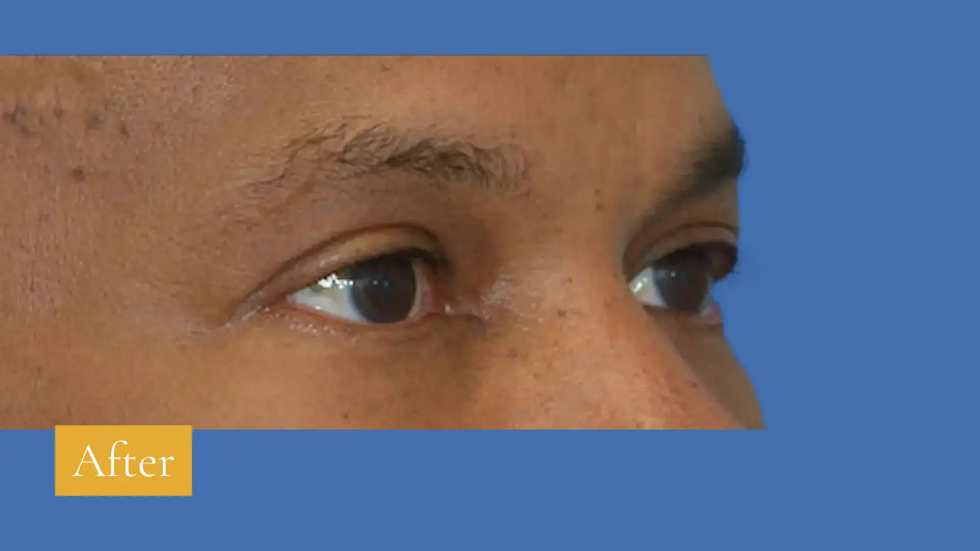 After lower eyelid surgery, click to view larger