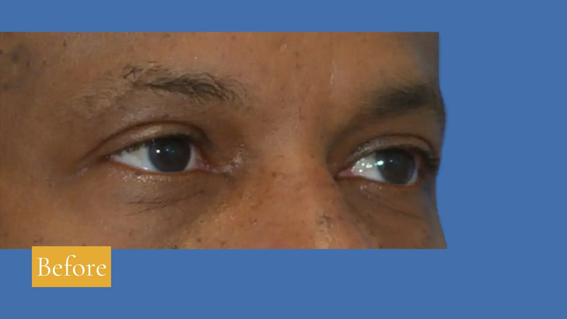 Before lower eyelid surgery, click to view larger