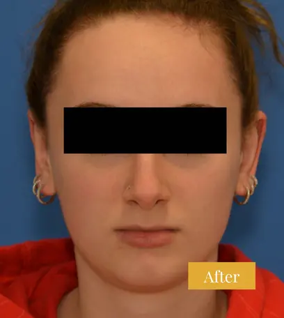 After otoplasty ear surgery, click to view larger