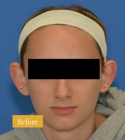 Before otoplasty ear surgery, click to view larger