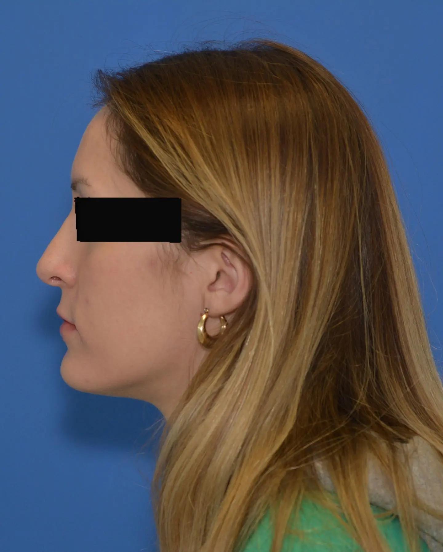After rhinoplasty, click to view larger