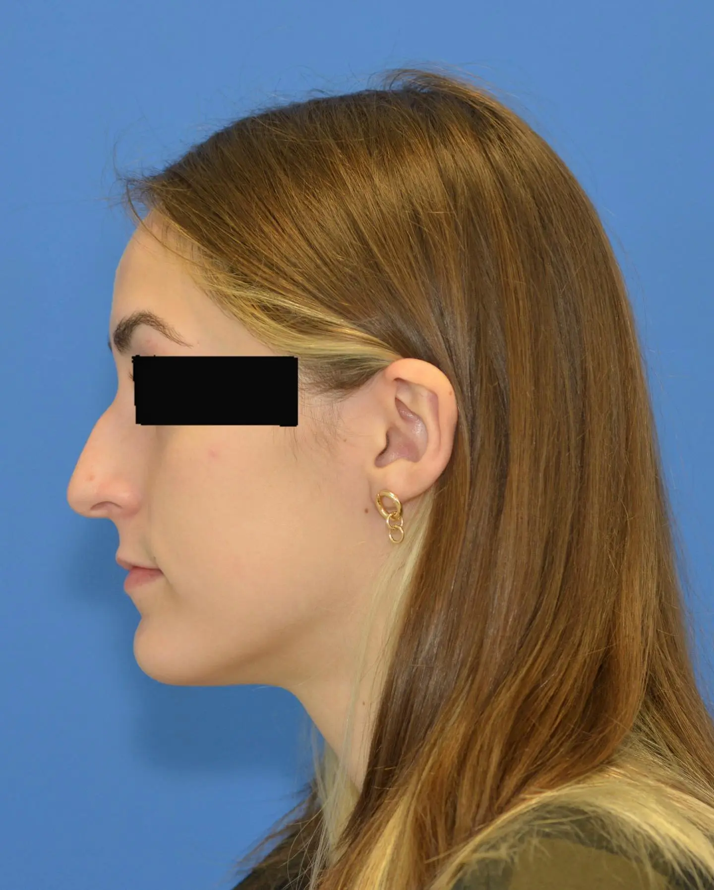 Before rhinoplasty, click to view larger