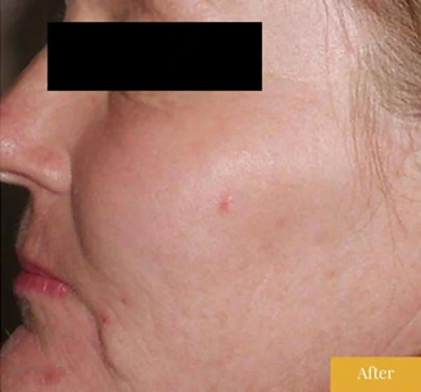 After Fraxel treatment, click to view larger