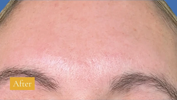 After Fraxel treatment, click to view larger