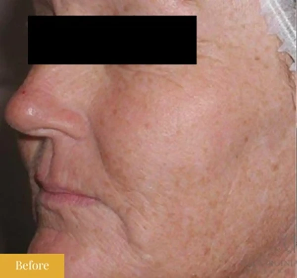 Before Fraxel treatment, click to view larger