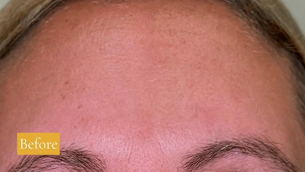 Before Fraxel treatment, click to view larger