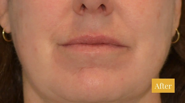 After Fraxel treatment, click to view larger