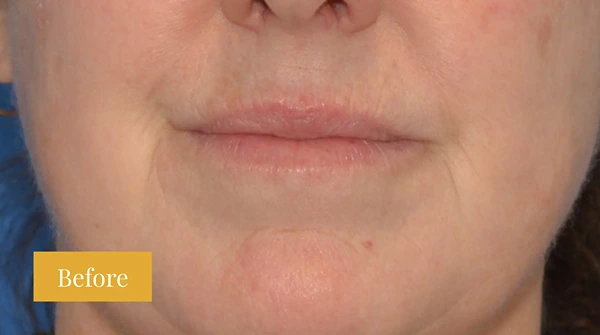 Before Fraxel treatment, click to view larger