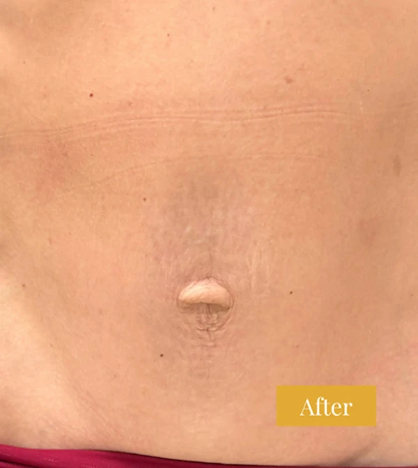 After Fraxel treatment on the abdomen, click to view larger