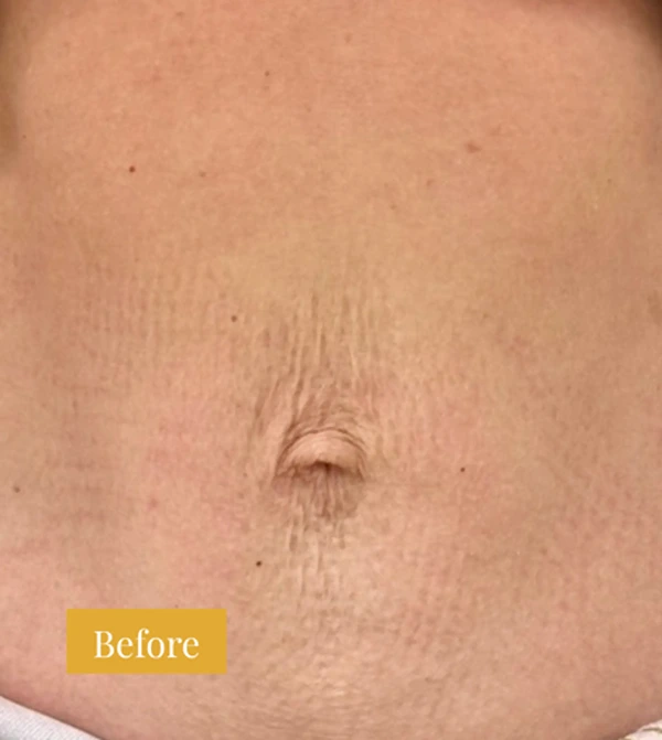 Before Fraxel treatment on the abdomen, click to view larger